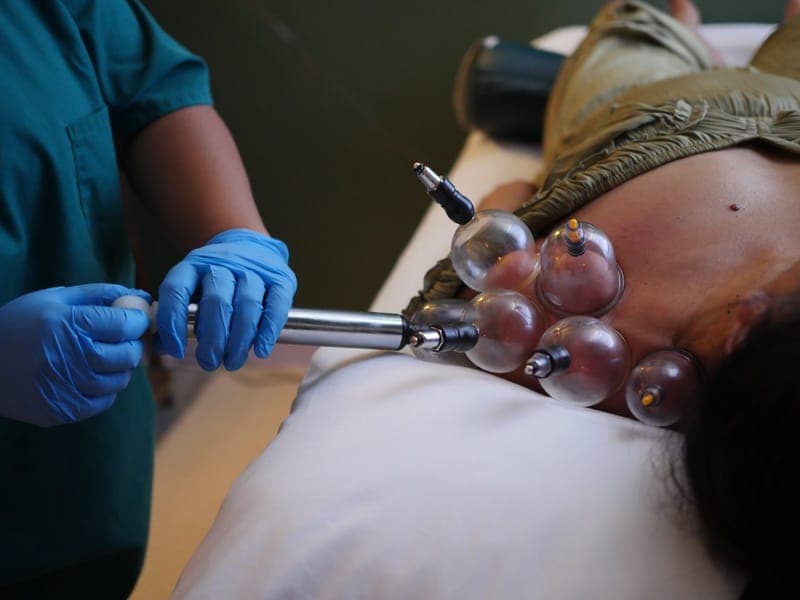 Cupping